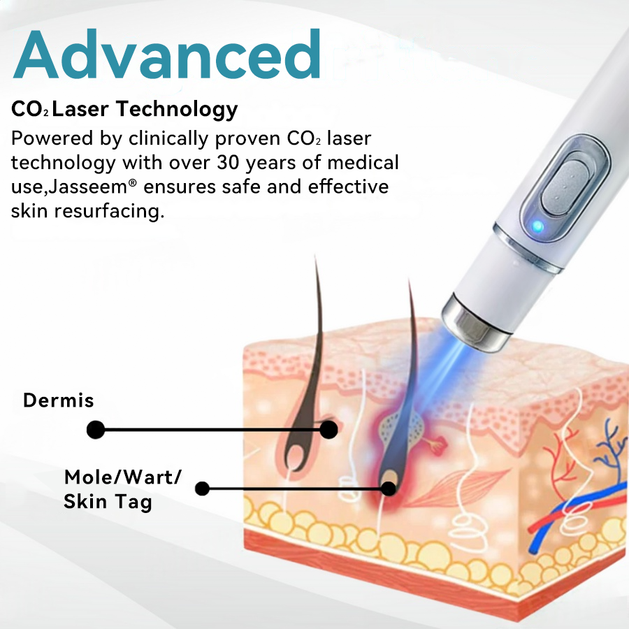 ๐๐๐ฌ๐ฌ๐๐๐ฆยฎ Medical-Grade Laser Pen ๐ฅ (Powered by COโ laser technology โ effectively removes moles, warts, skin tags, pigmentation marks, and other skin imperfections)๐