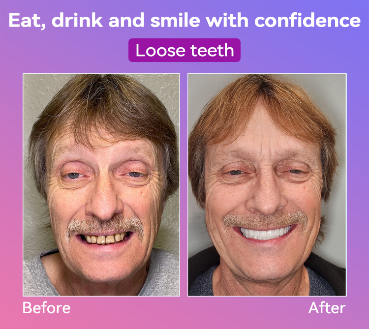 𝐉𝐚𝐬𝐬𝐞𝐞𝐦® Latest Premium Comfort Dentures👩‍⚕️🎉 (High-End Dentures, Easy to Wear - Limited Time 70% Discount)
