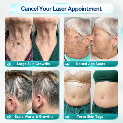 ✨✨𝐄𝐦𝐞𝐦𝐚𝐱®𝟐-𝐢𝐧-𝟏 𝐌𝐢𝐜𝐫𝐨𝐧𝐞𝐞𝐝𝐥𝐞 & 𝐇𝐲𝐝𝐫𝐨𝐜𝐨𝐥𝐥𝐨𝐢𝐝 𝐌𝐨𝐥𝐞 𝐑𝐞𝐦𝐨𝐯𝐚𝐥 𝐏𝐚𝐭𝐜𝐡(Zero Pain, Zero 𝐒𝐜𝐚𝒓𝒔 patch)💪
