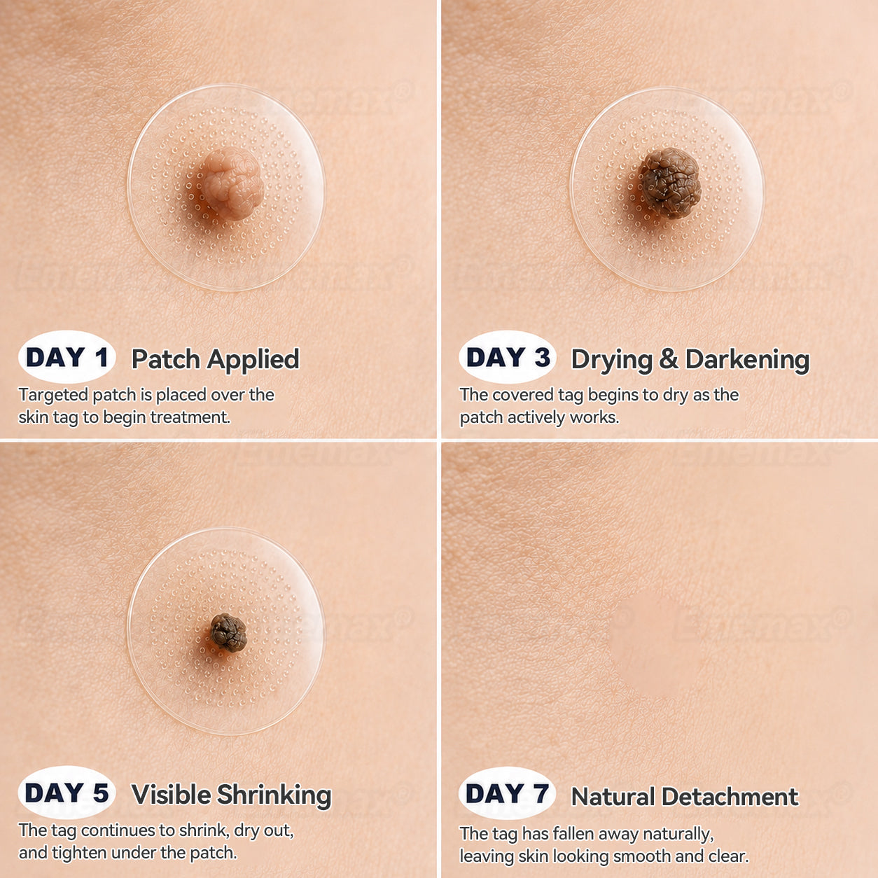 ✨✨𝐄𝐦𝐞𝐦𝐚𝐱®𝟐-𝐢𝐧-𝟏 𝐌𝐢𝐜𝐫𝐨𝐧𝐞𝐞𝐝𝐥𝐞 & 𝐇𝐲𝐝𝐫𝐨𝐜𝐨𝐥𝐥𝐨𝐢𝐝 𝐌𝐨𝐥𝐞 𝐑𝐞𝐦𝐨𝐯𝐚𝐥 𝐏𝐚𝐭𝐜𝐡(Zero Pain, Zero 𝐒𝐜𝐚𝒓𝒔 patch)💪