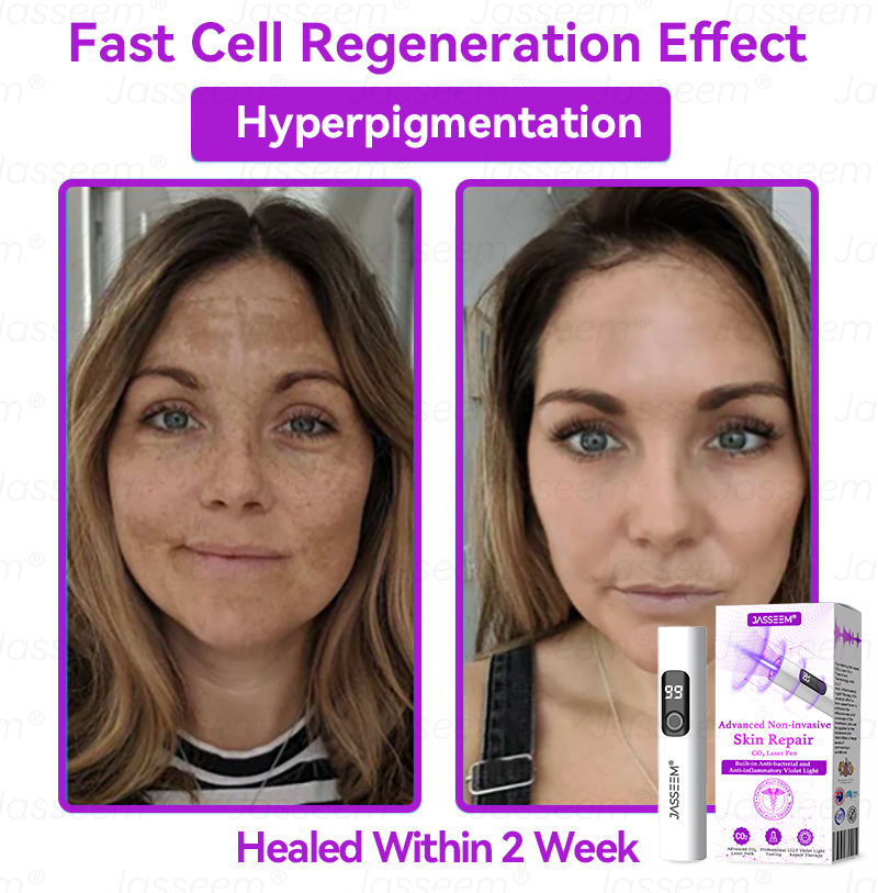 🔥 Only 10 left — 50% off today! 🎉 The 𝐉𝐚𝐬𝐬𝐞𝐞𝐦® Advanced Non-Invasive CO₂ Laser Pen is the perfect gift — whether as a backup for yourself or for family, friends, or someone special.