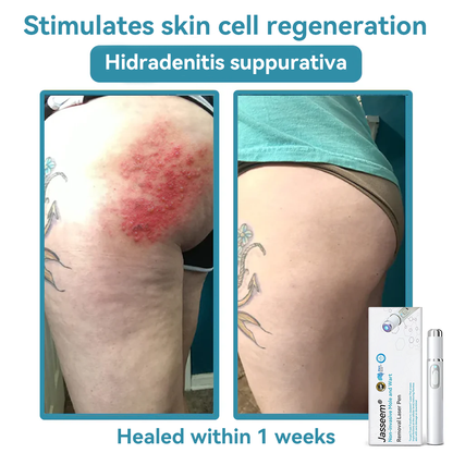 𝐉𝐚𝐬𝐬𝐞𝐞𝐦® Medical-Grade Laser Pen 🔥 (Powered by CO₂ laser technology – effectively removes moles, warts, skin tags, pigmentation marks, and other skin imperfections)🏆