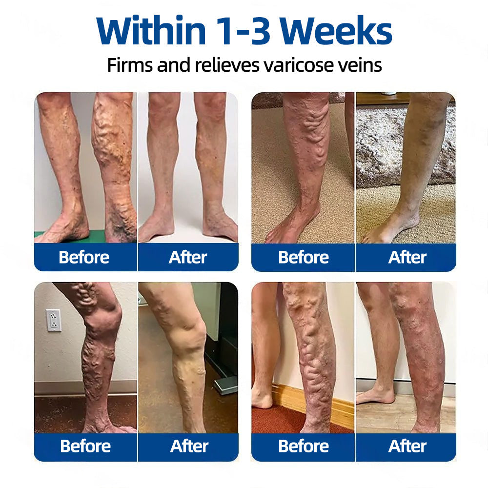 🛡️ 𝐅𝐥𝐨𝐫𝐢𝐬𝐦𝐚® 🎉 Diosmin & Hesperidin Clinical‑Grade Microneedle Patch — an advanced herbal formula designed to help reduce the appearance of spider veins and varicose veins, while easing the feeling of heavy, tired legs. 👩‍⚕️
