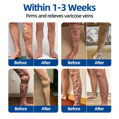 🛡️ 𝐅𝐥𝐨𝐫𝐢𝐬𝐦𝐚® 🎉 Diosmin & Hesperidin Clinical‑Grade Microneedle Patch — an advanced herbal formula designed to help reduce the appearance of spider veins and varicose veins, while easing the feeling of heavy, tired legs. 👩‍⚕️