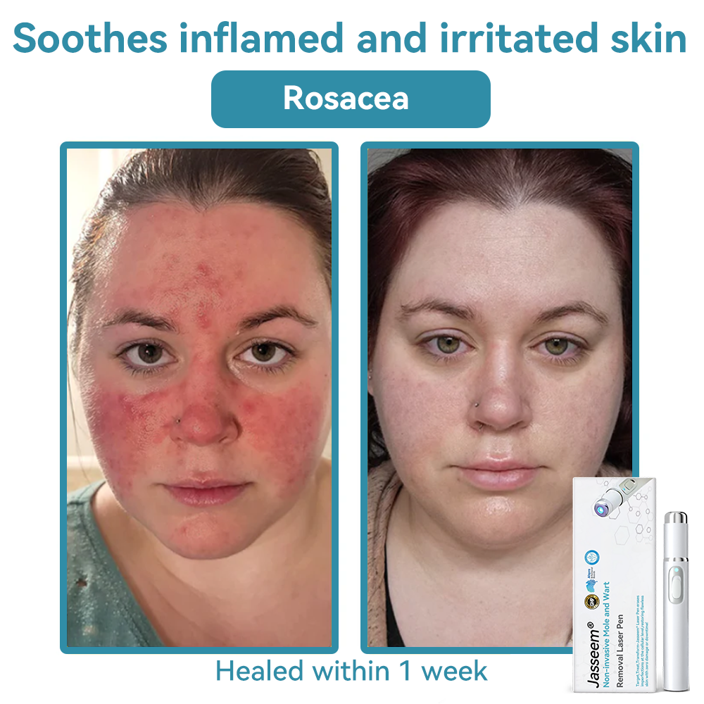 1 Piece – (Non-invasive professional mole & wart removal)